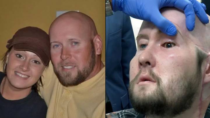 World’s first whole-eye transplant performed on a US veteran